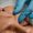 Close up of dermal fillers being injected to forehead